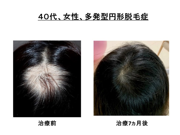 円形脱毛症　病院